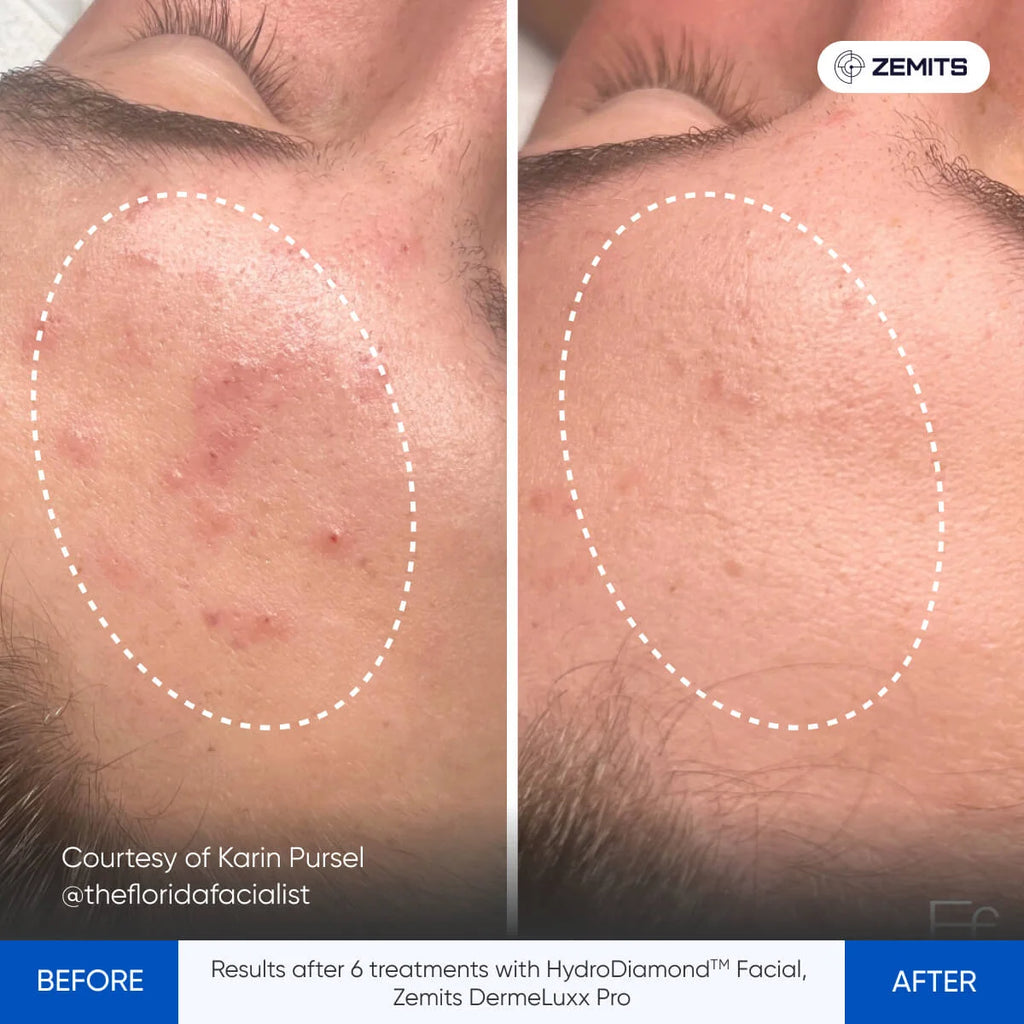 Before and after hydrodermabrasion results Zemits DermeLuxx Pro