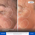 Before and after hydrodermabrasion results Zemits DermeLuxx Pro