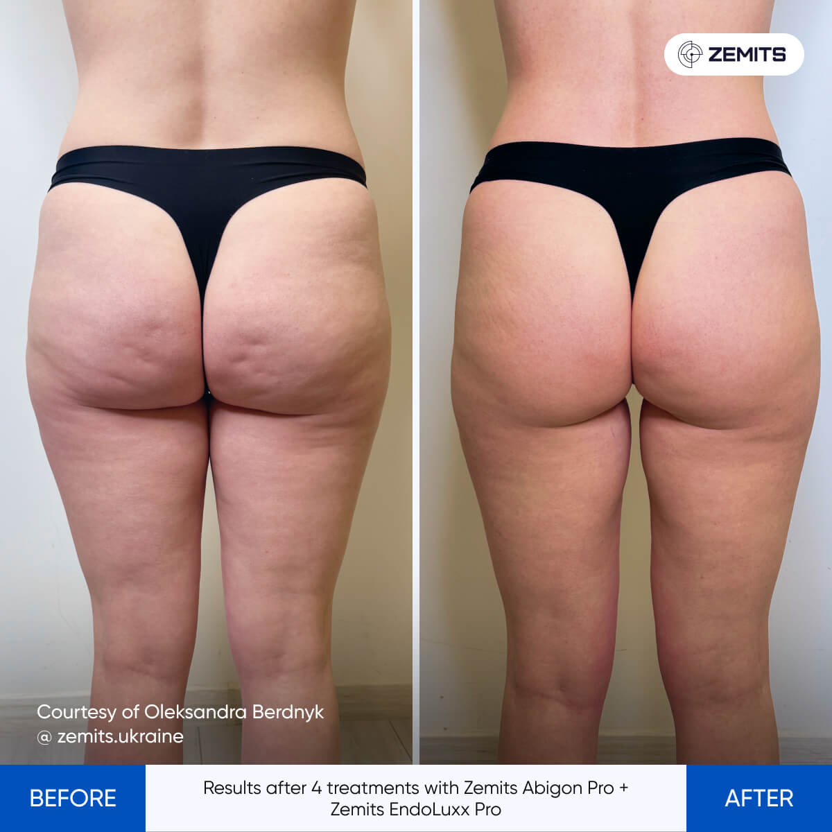 Before and after contouring results Zemits EndoLuxx Pro