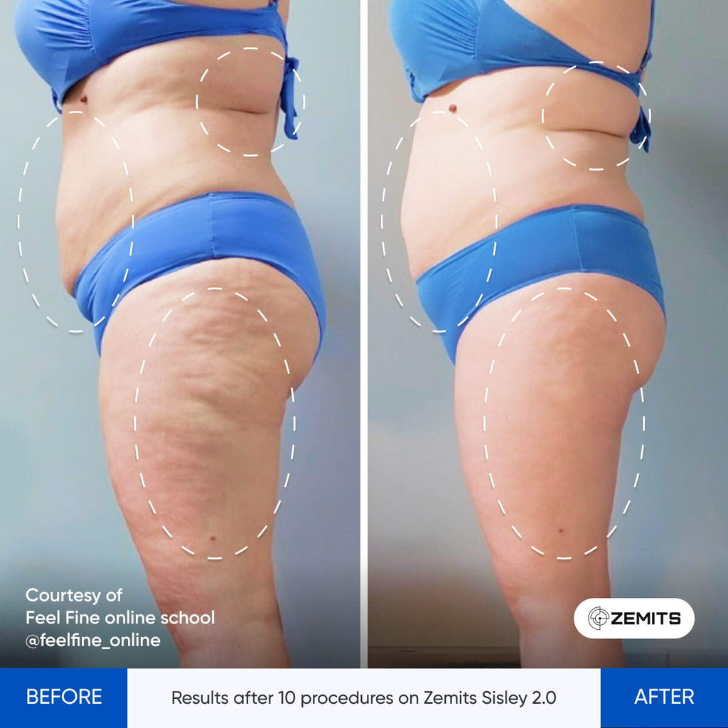 Before and after lymphatic drainage results Zemits Sisley 2.0