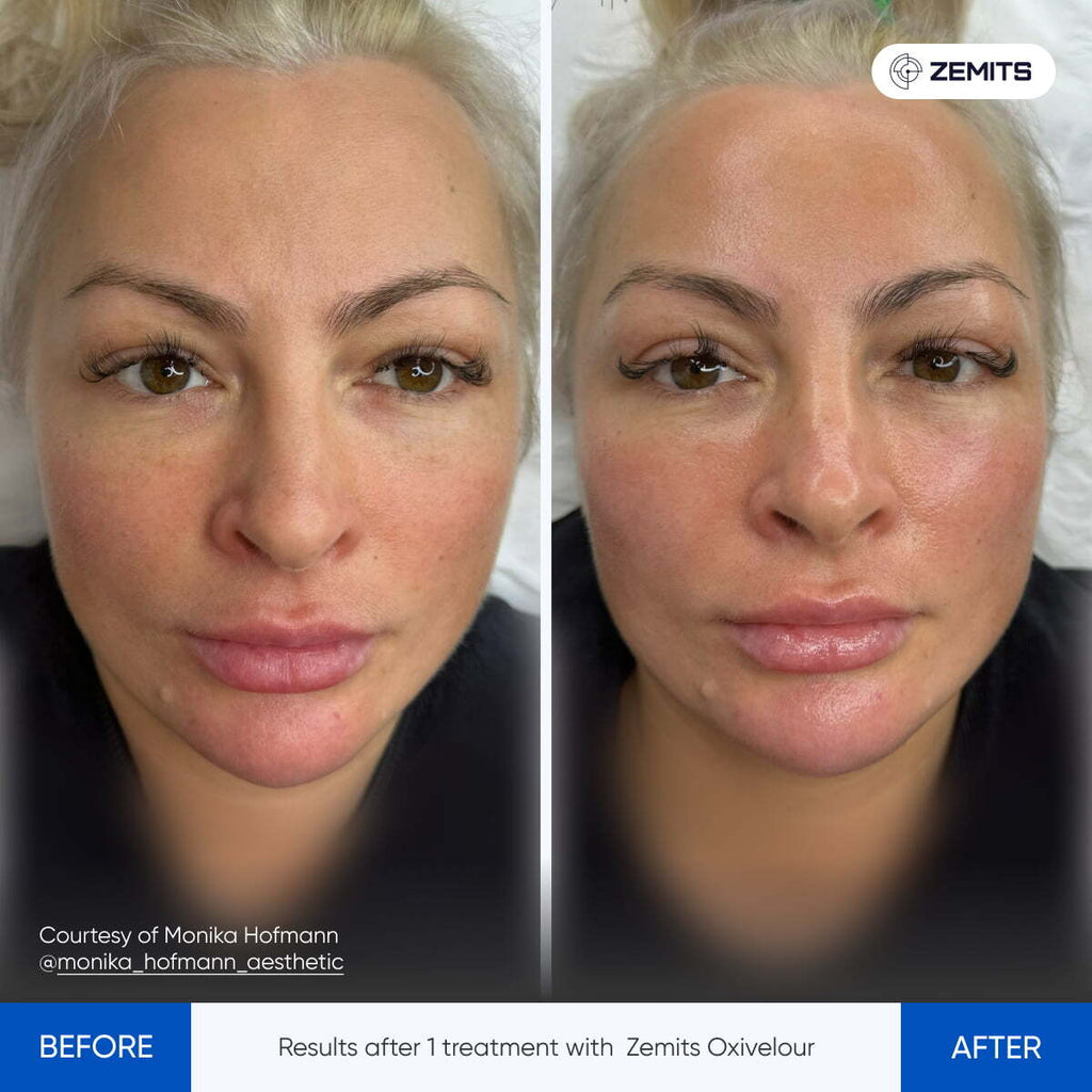 Before and after oxygen facial results Zemits OxiVelour