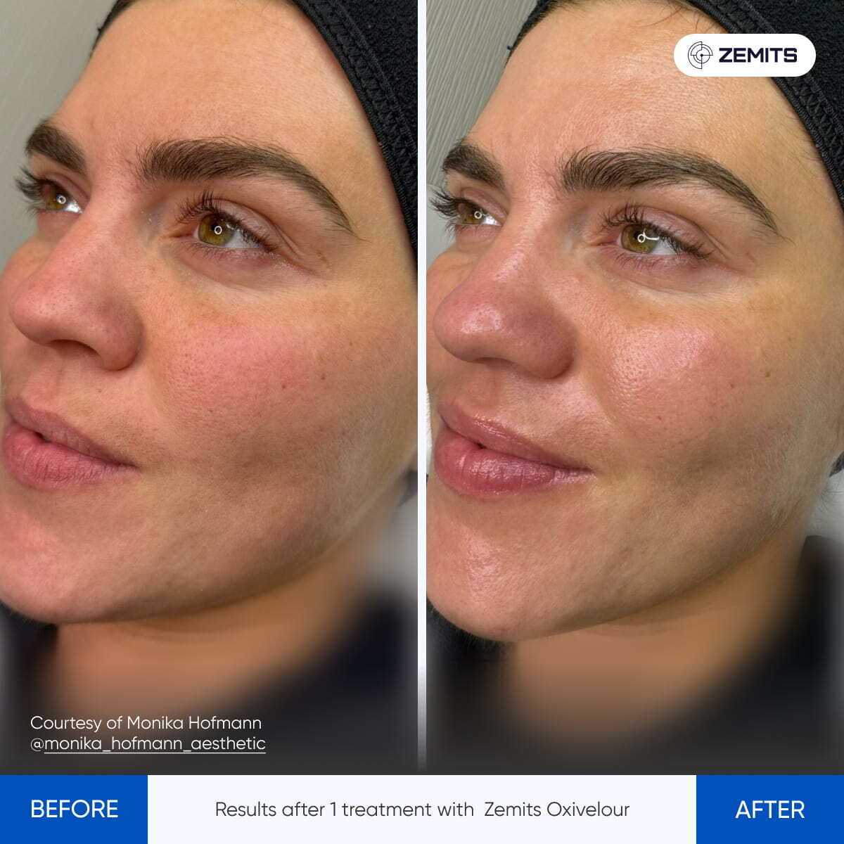 Before and after oxygen facial results Zemits OxiVelour