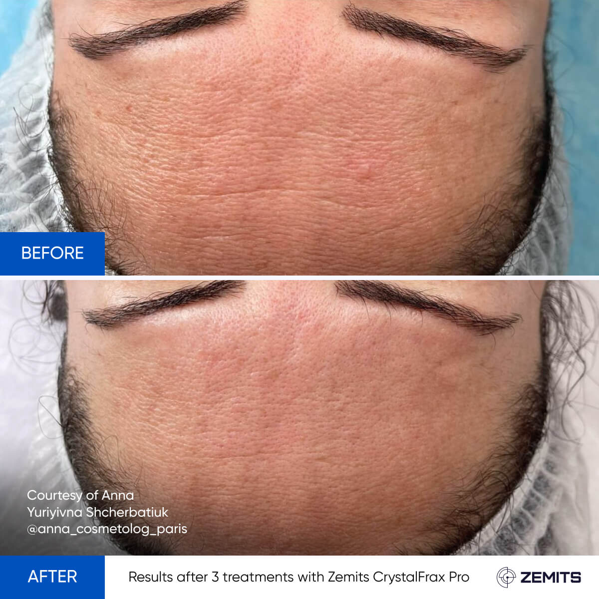 Before and after fractional RF results CrystalFrax Pro MD