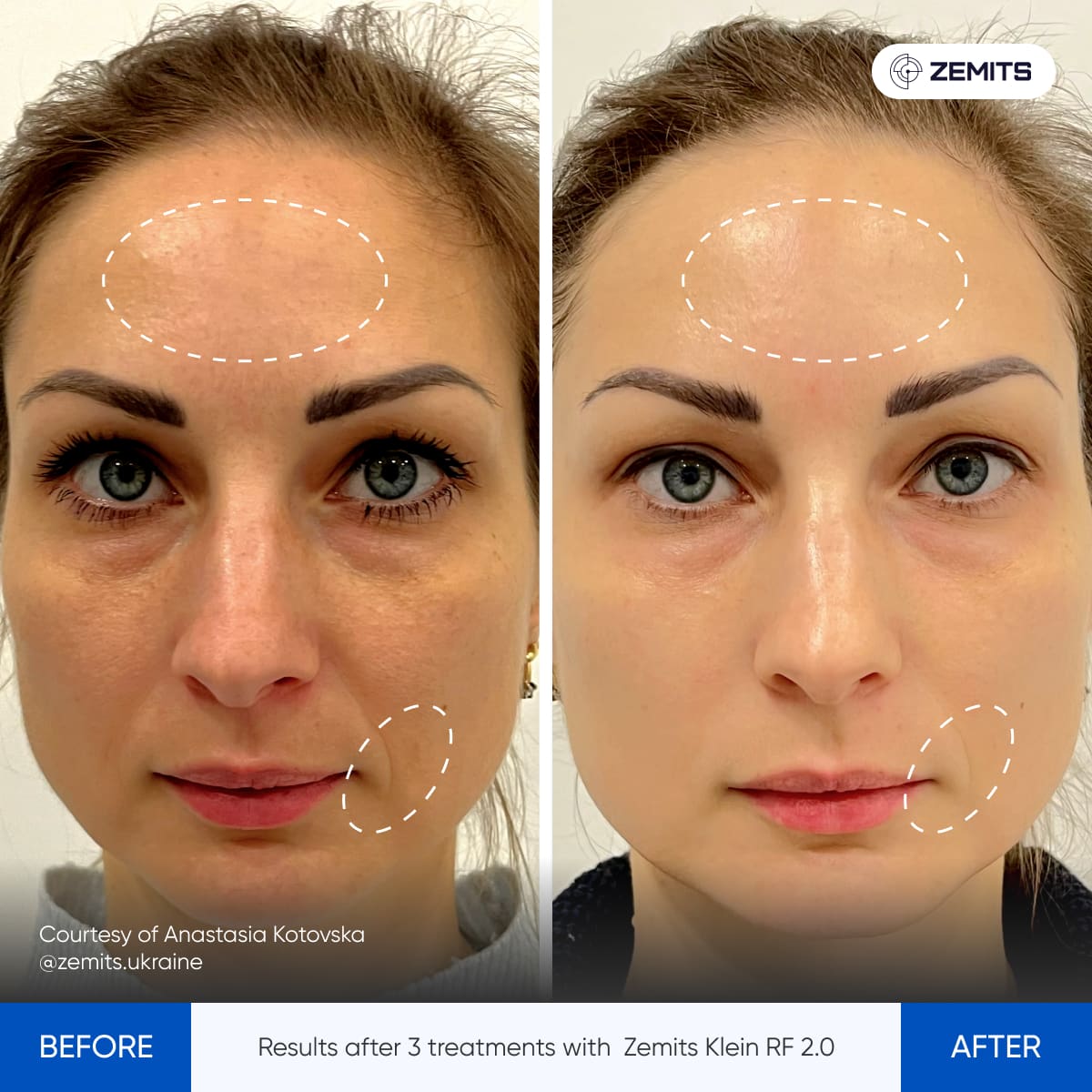 Before After Slide 19