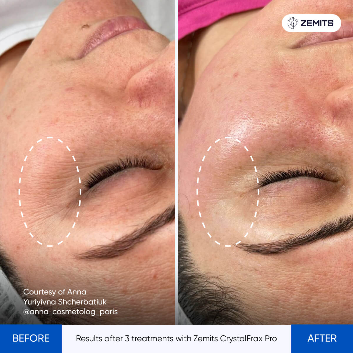 Before and after fractional RF results CrystalFrax Pro MD