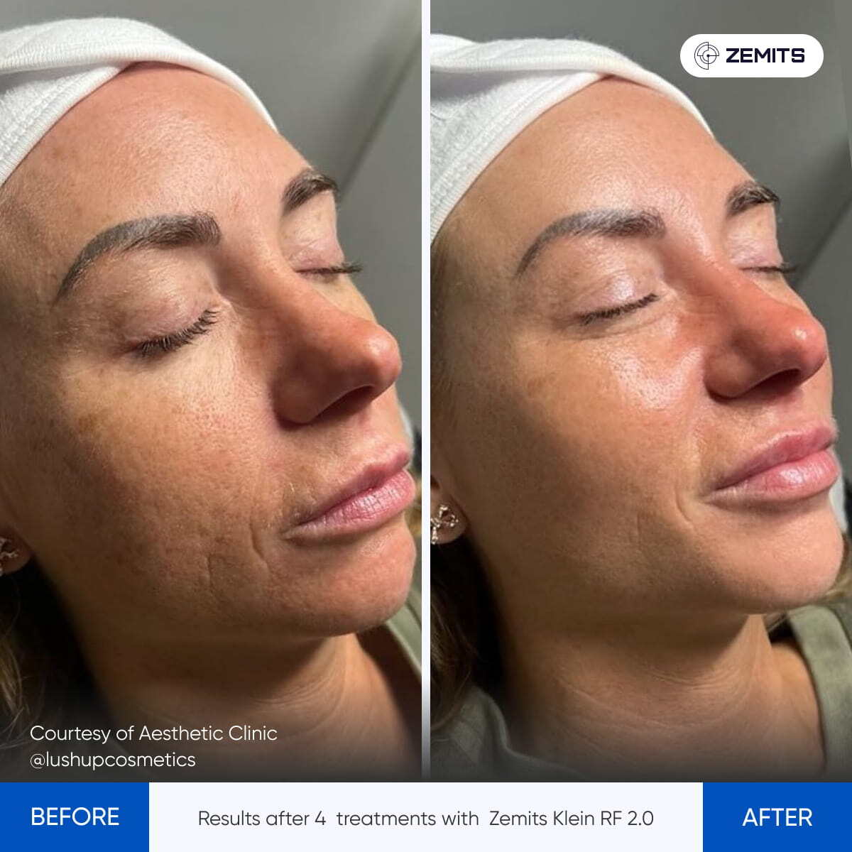 Before and after radiofrequency results Zemits Klein RF 2.0