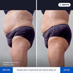 Before and after lymphatic drainage results Zemits Sisley 2.0