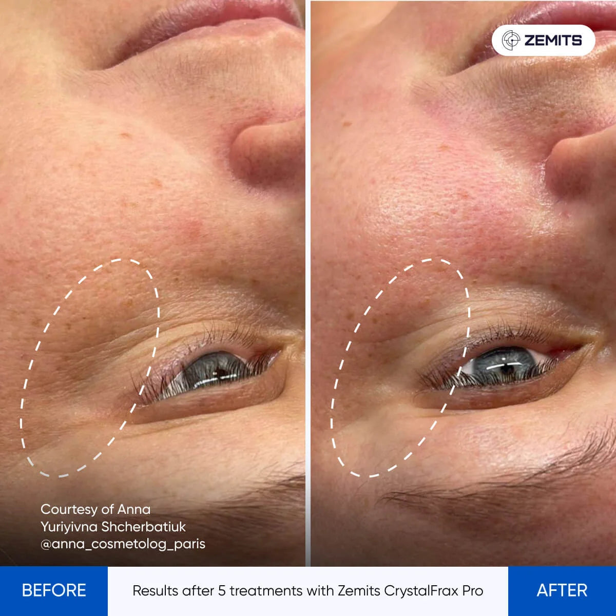 Before and after fractional RF results CrystalFrax Pro MD