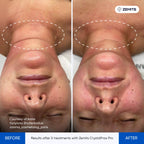 Before and after fractional RF results CrystalFrax Pro MD