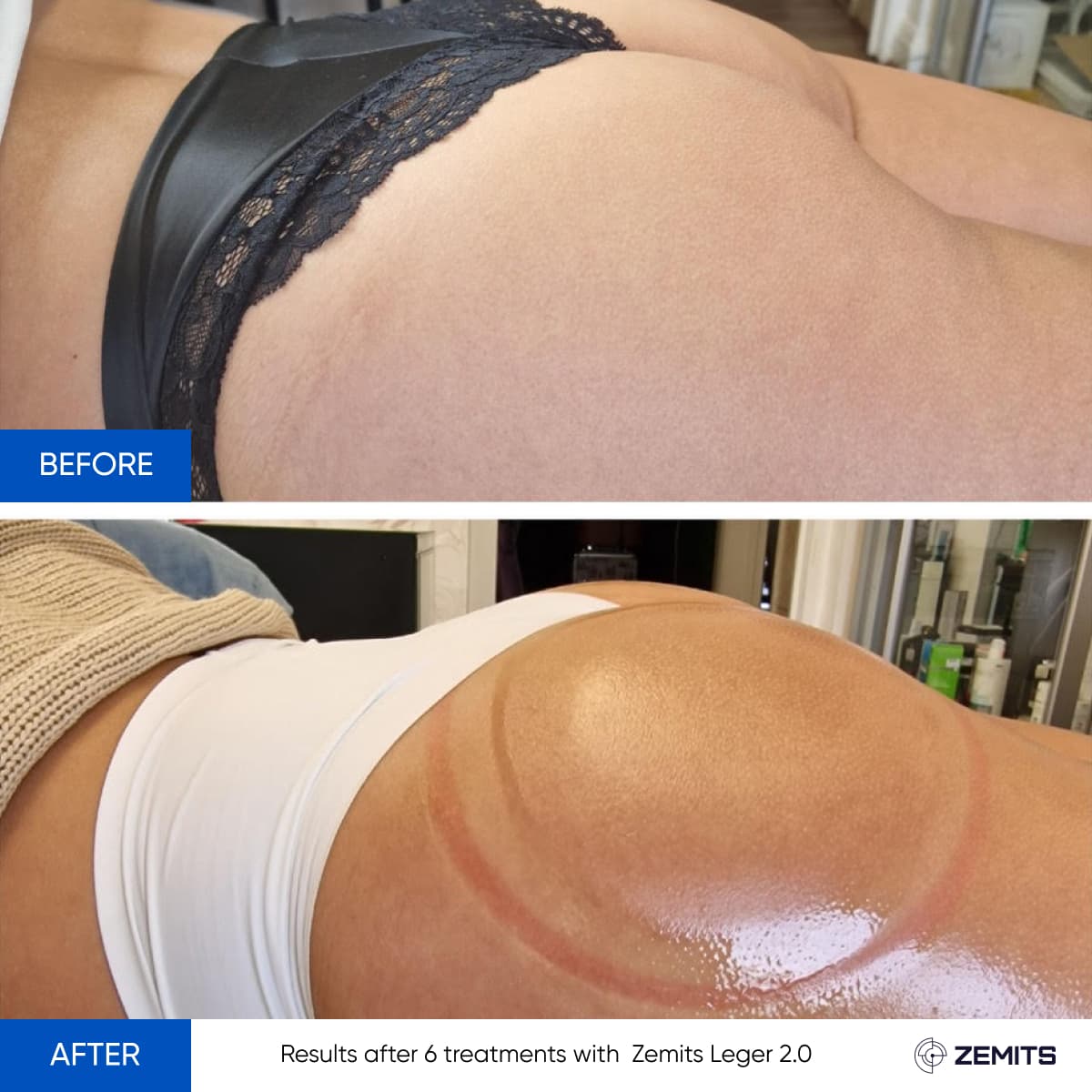 Before and after vacuum body sculpting results Zemits Leger 2.0