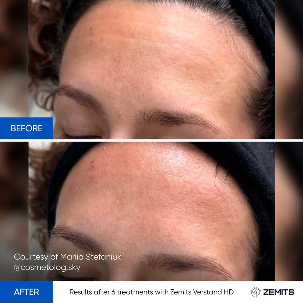 Before and after facial treatment results Zemits Verstand HD