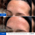 Before and after facial treatment results Zemits Verstand HD