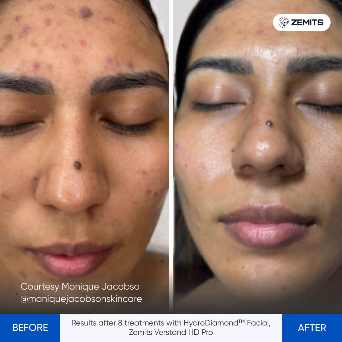Before and after facial treatment results Zemits Verstand HD