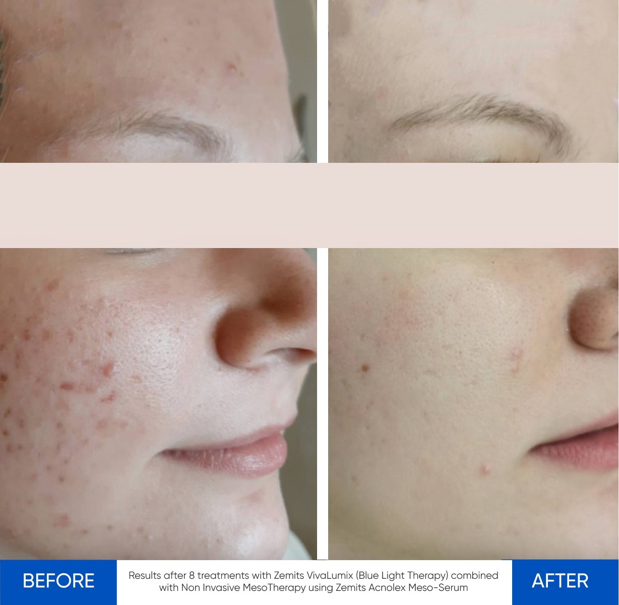 Before and after LED light therapy results Zemits VivaLumix