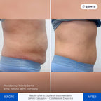 Before and after cellulite reduction results Zemits CelluSpice Pro