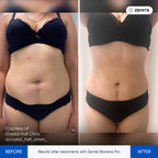 Before and after body contouring results Zemits Bionexis Pro