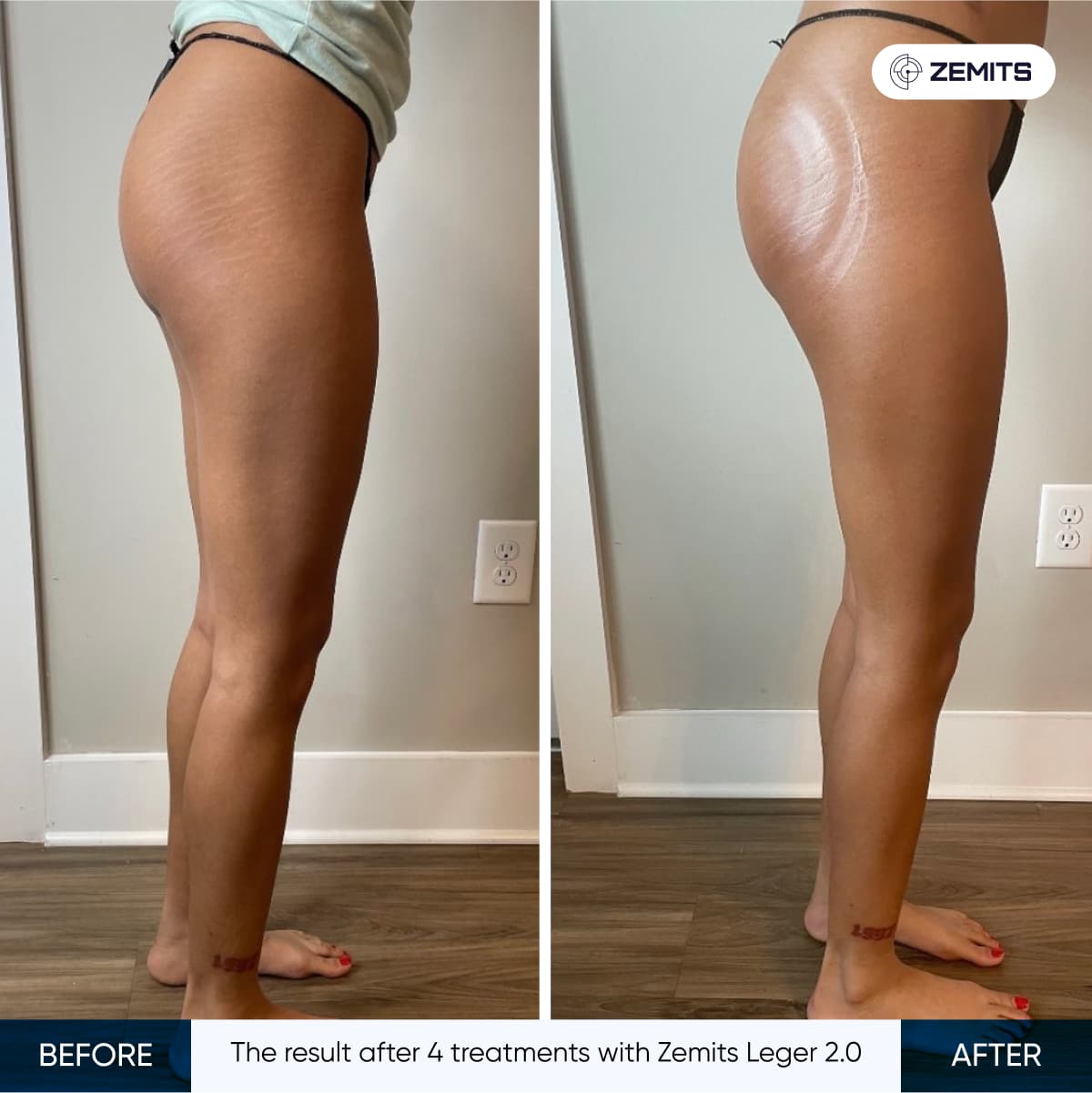 Before and after vacuum body sculpting results Zemits Leger 2.0