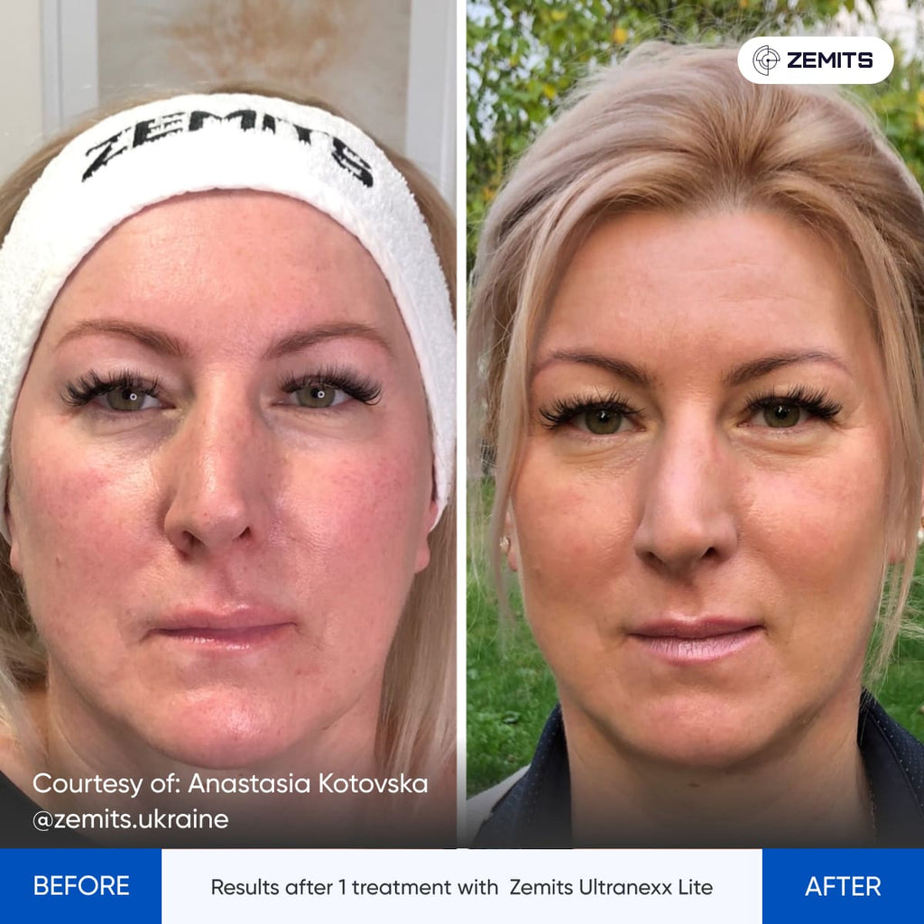 Before and after HIFU facelift results Zemits UltraNexx Lite
