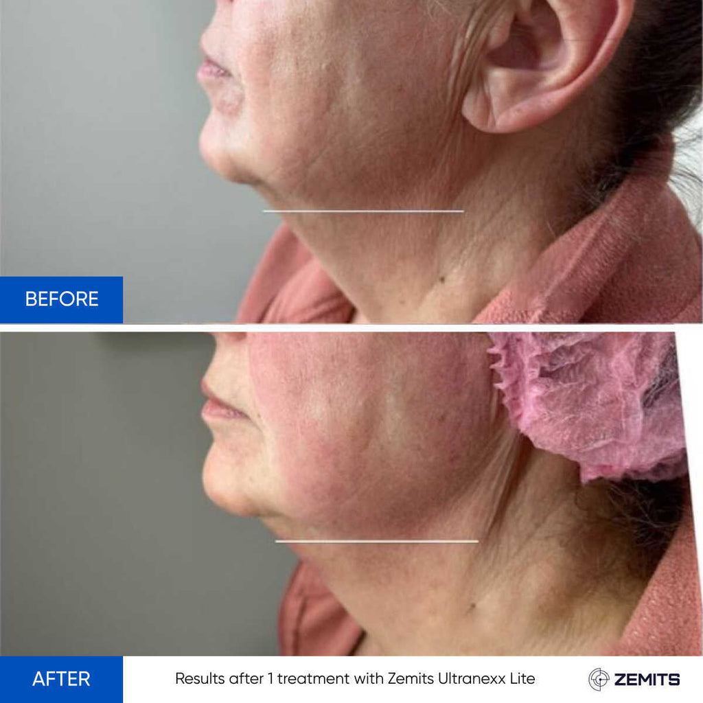 Before and after HIFU facelift results Zemits UltraNexx Lite