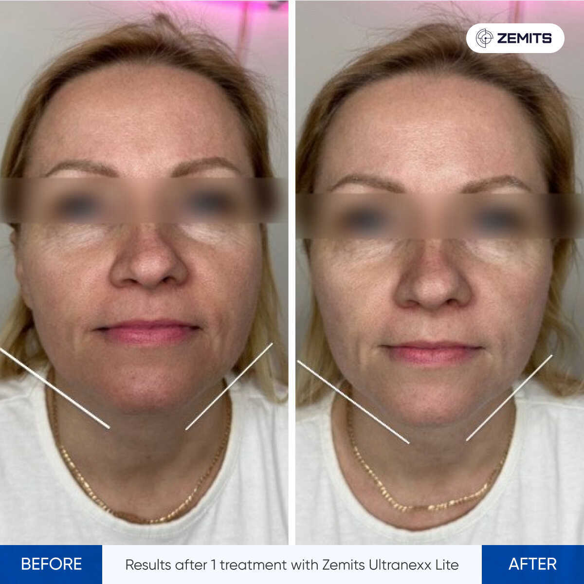 Before and after HIFU facelift results Zemits UltraNexx Lite