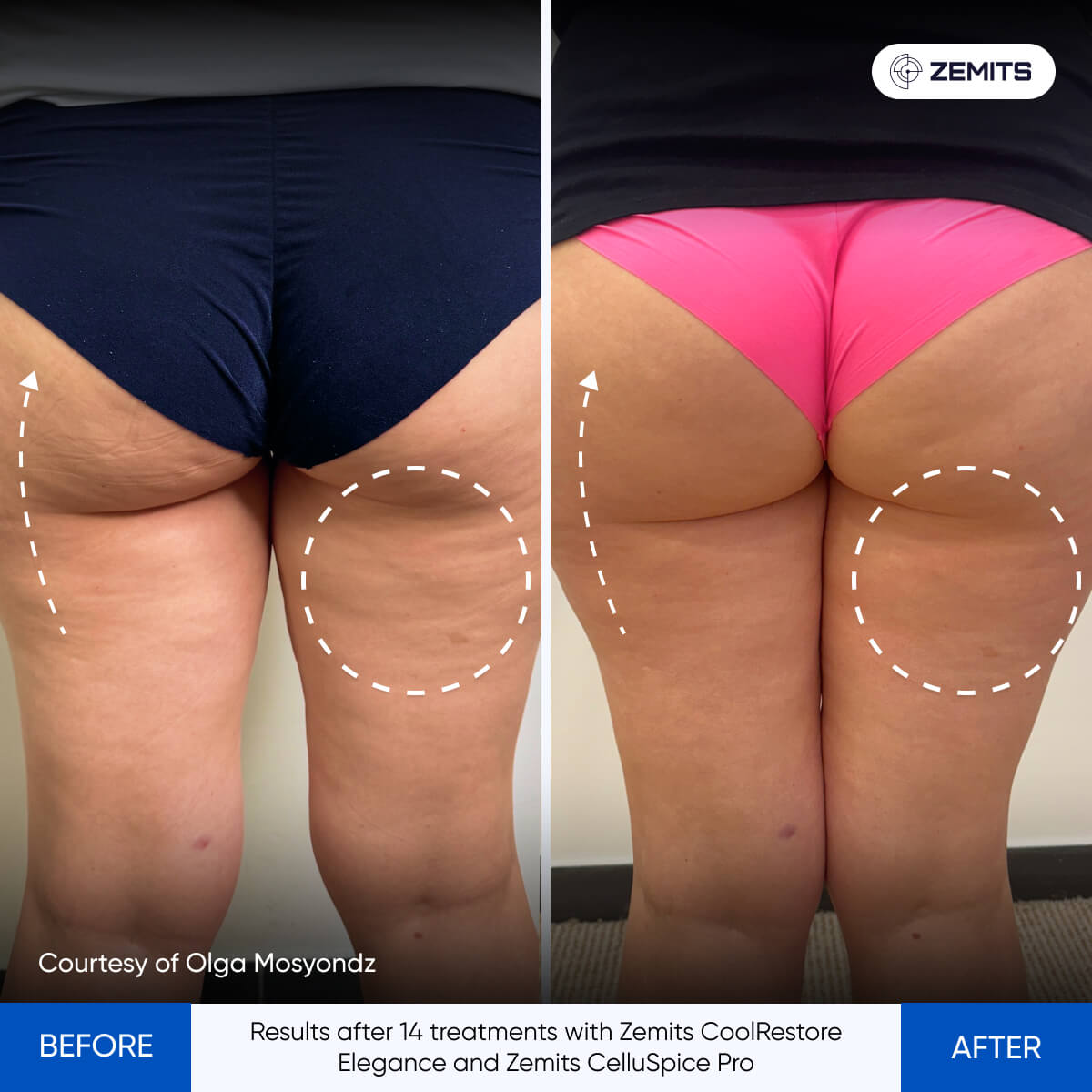 Before and after cellulite reduction results Zemits CelluSpice Pro