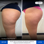 Before and after cellulite reduction results Zemits CelluSpice Pro