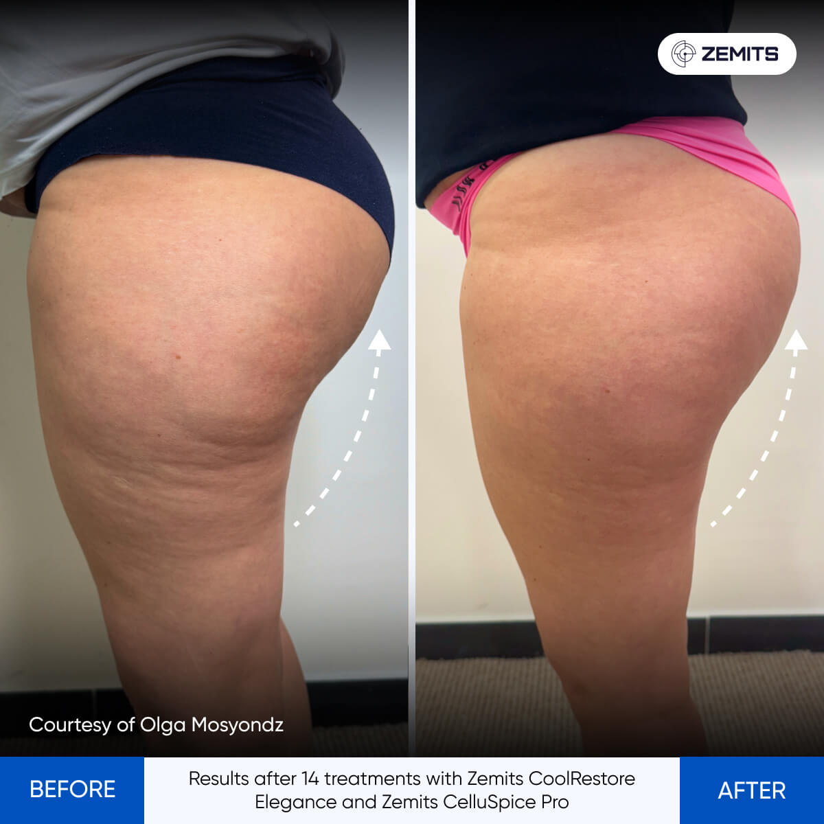Before and after cellulite reduction results Zemits CelluSpice Pro