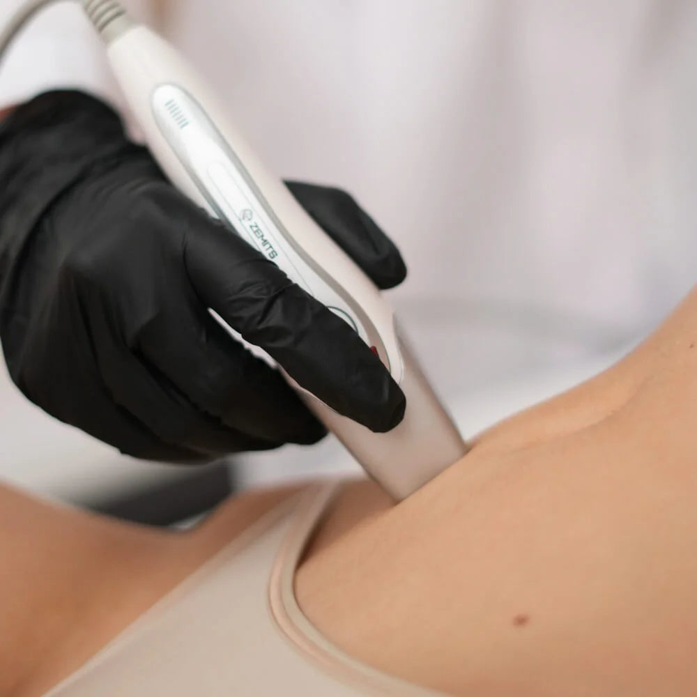 Fractional RF treatment with Zemits CrystalFrax Pro MD