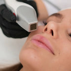 Fractional RF treatment with Zemits CrystalFrax Pro MD