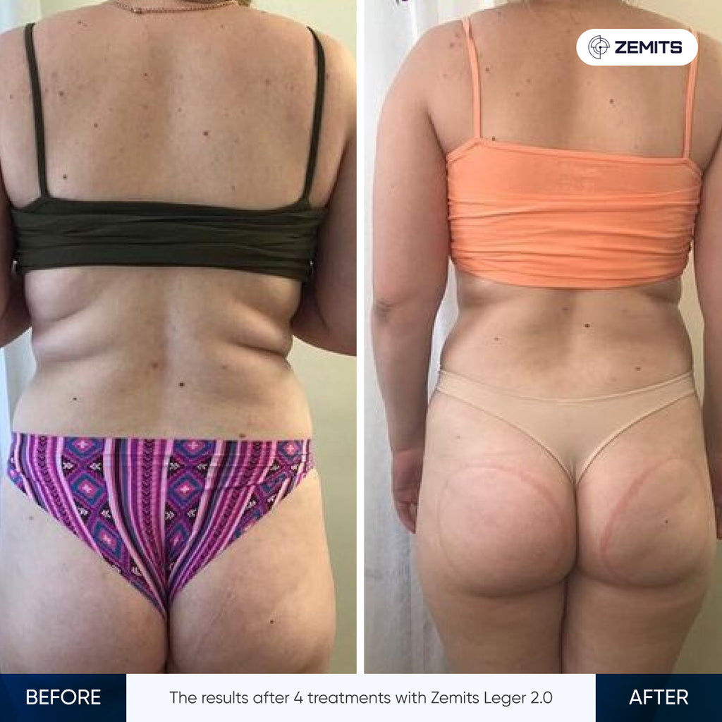 Before and after vacuum body sculpting results Zemits Leger 2.0