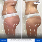 Before and after body sculpting results Zemits Abigon Pro