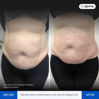Before and after results of Zemits Abigon Pro treatment on a person's abdomen.