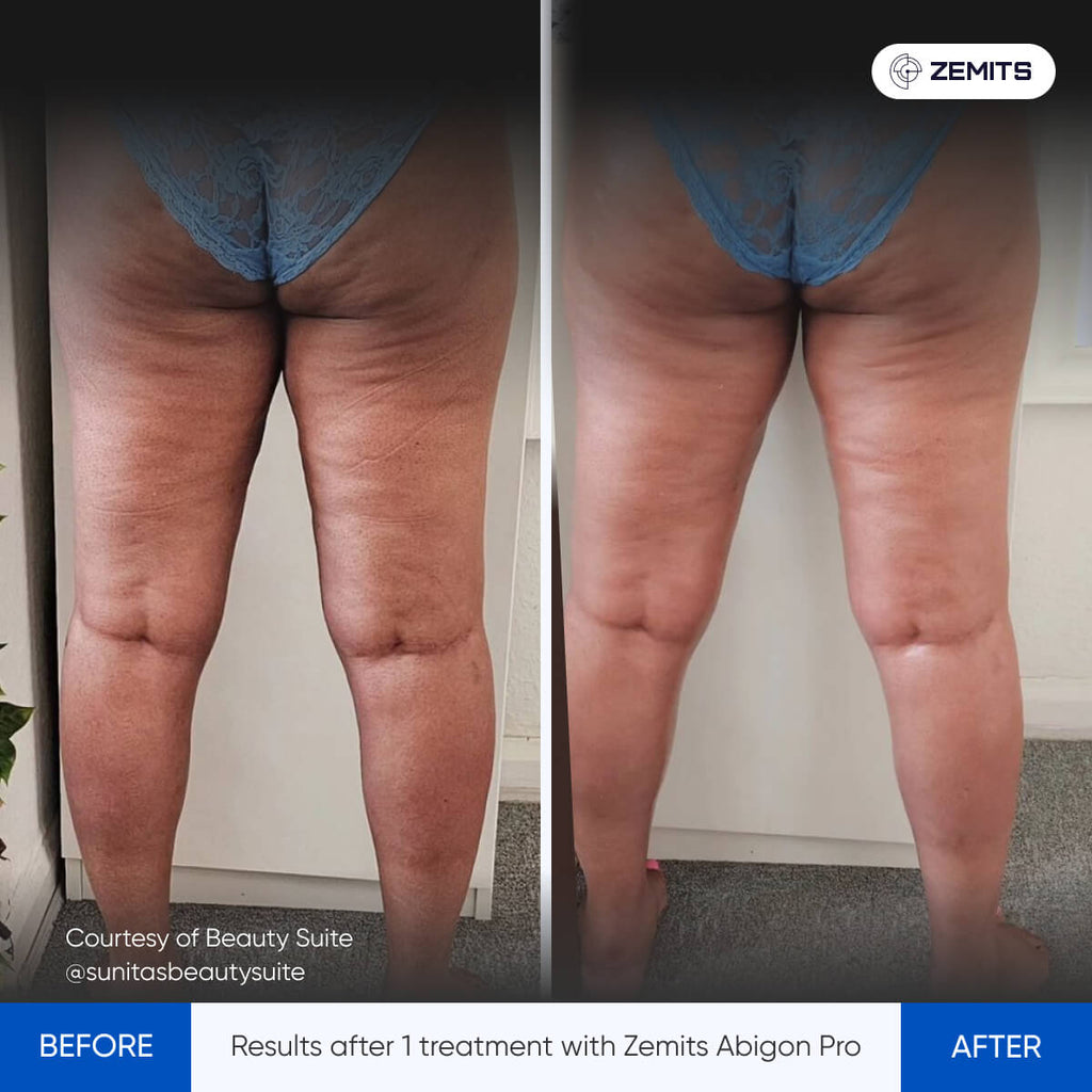 Before and after body sculpting results Zemits Abigon Pro
