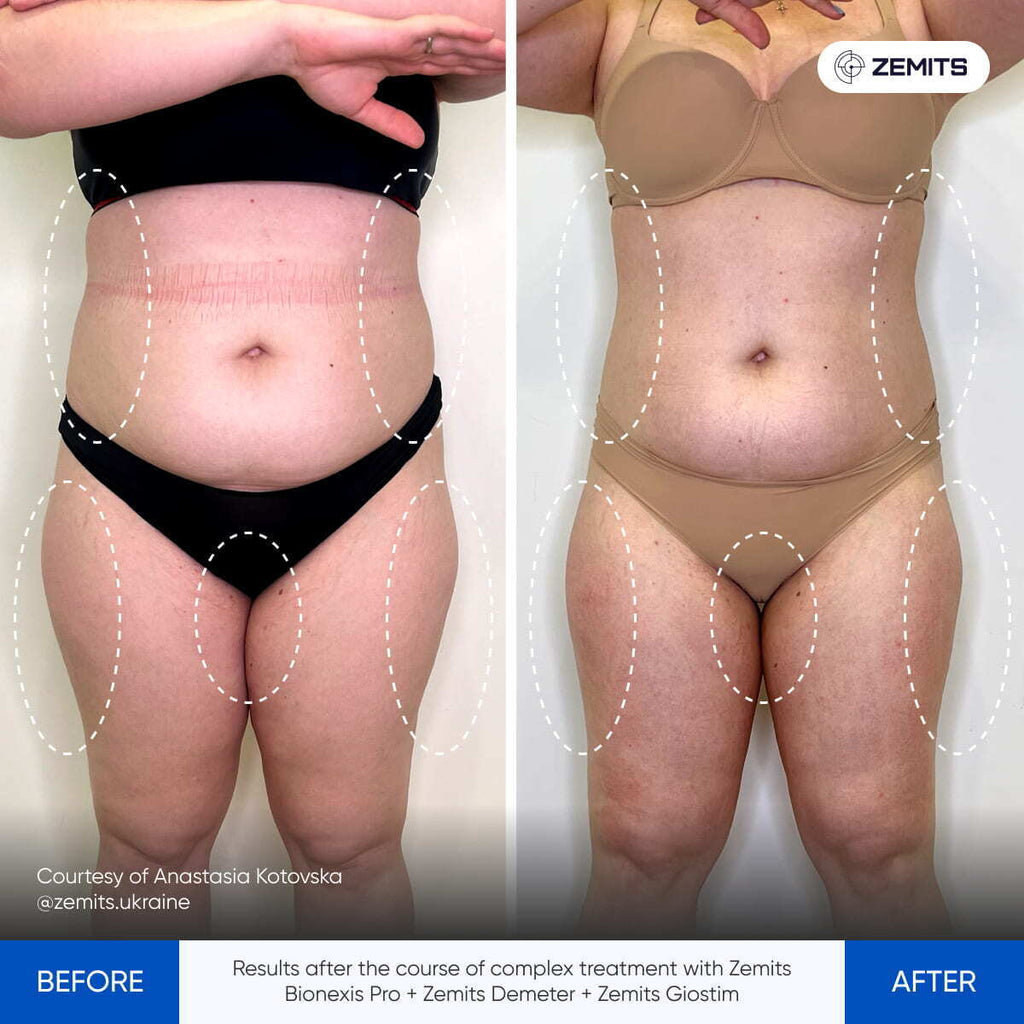Before and after body contouring results Zemits Bionexis Pro