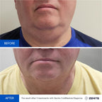 Before and after cryotherapy results Zemits ColdRestore Elegance