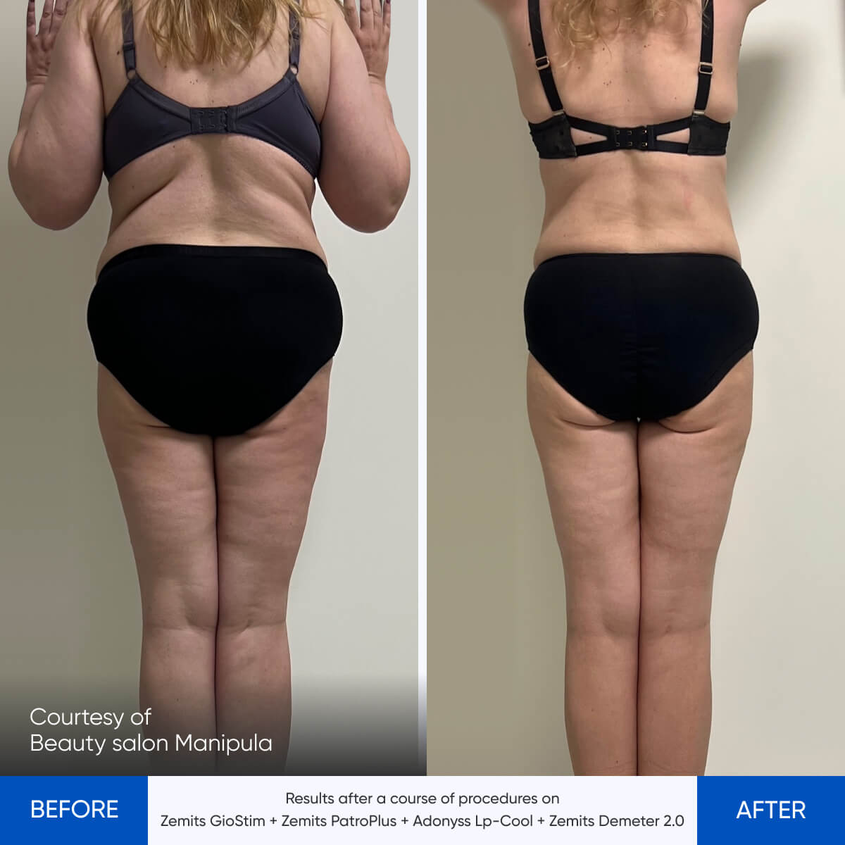 Before and after pressotherapy results Zemits Demeter 2.0