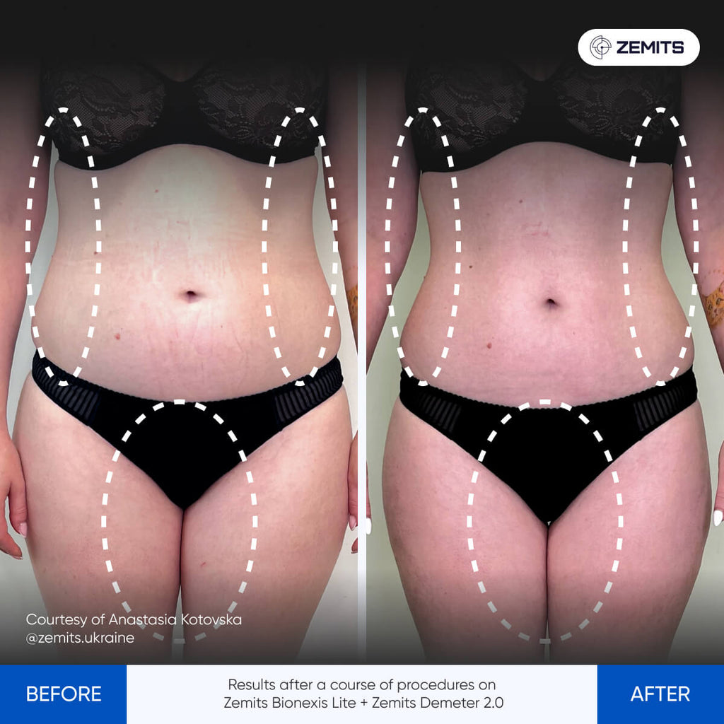 Before and after pressotherapy results Zemits Demeter 2.0