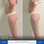 Before and after pressotherapy results Zemits Demeter 2.0
