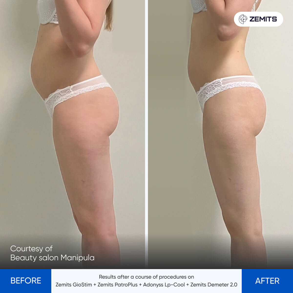 Before and after pressotherapy results Zemits Demeter 2.0