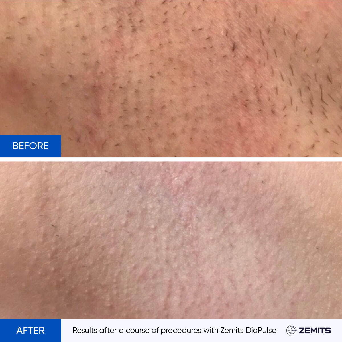 Before and after laser hair removal results Zemits DioPulse