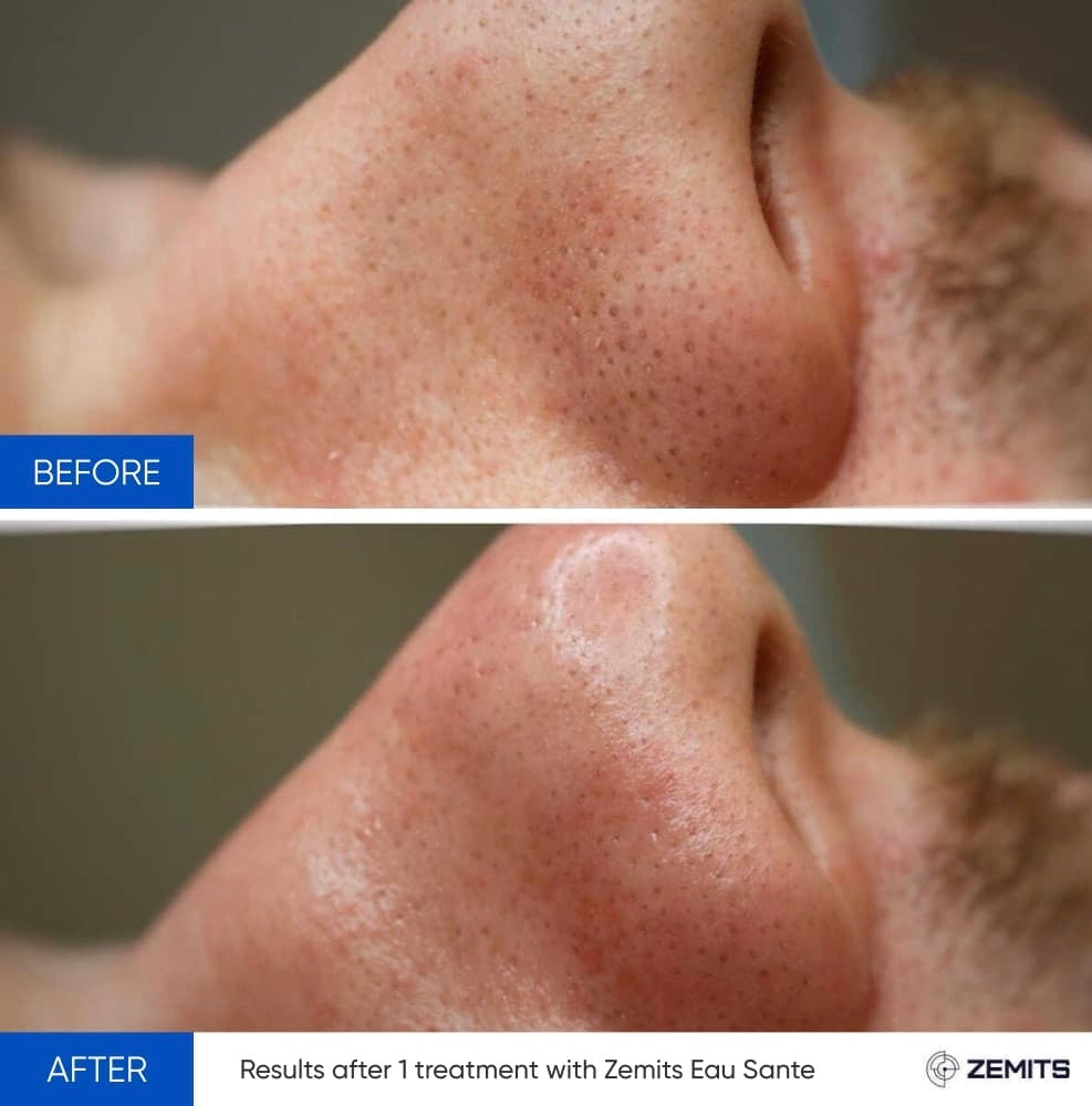 Before and after hydrodermabrasion results Zemits Eau Sante