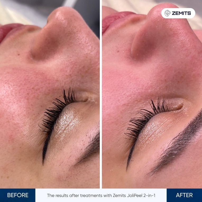 Before and after microdermabrasion results Zemits JoliPeel