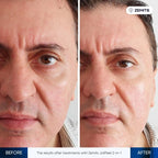 Before and after microdermabrasion results Zemits JoliPeel