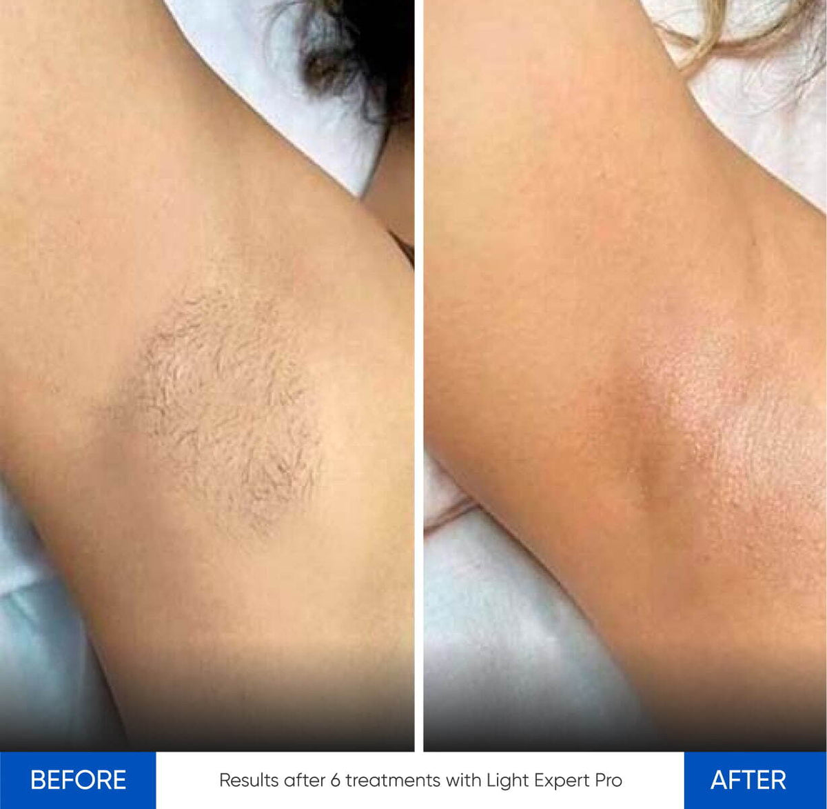 Before After Slide 1