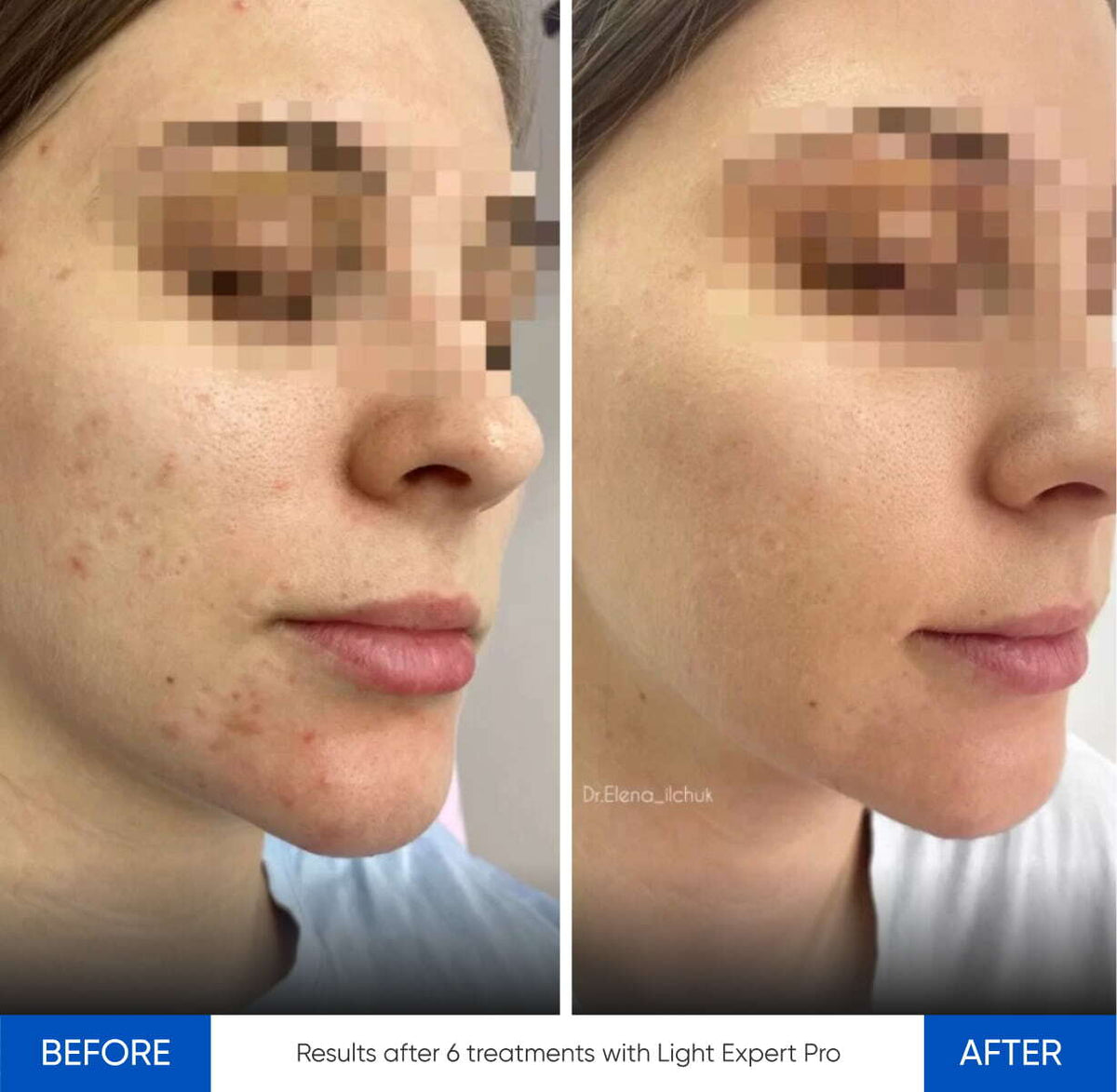 Before After Slide 4