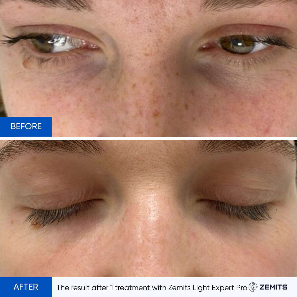 Before and after IPL treatment results Zemits Light Expert Pro