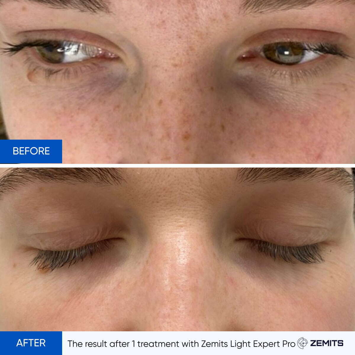 Before and after IPL treatment results Zemits Light Expert Pro