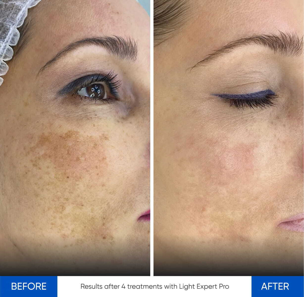 Before and after IPL treatment results Zemits Light Expert Pro