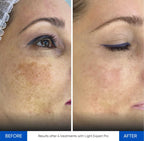 Before and after IPL treatment results Zemits Light Expert Pro