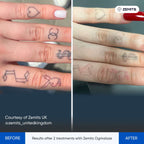 Before and after tattoo removal results Zemits OgmaLaze